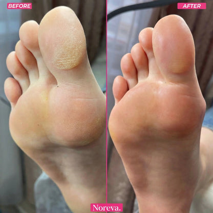 Noreva FootGlow Callus Remover