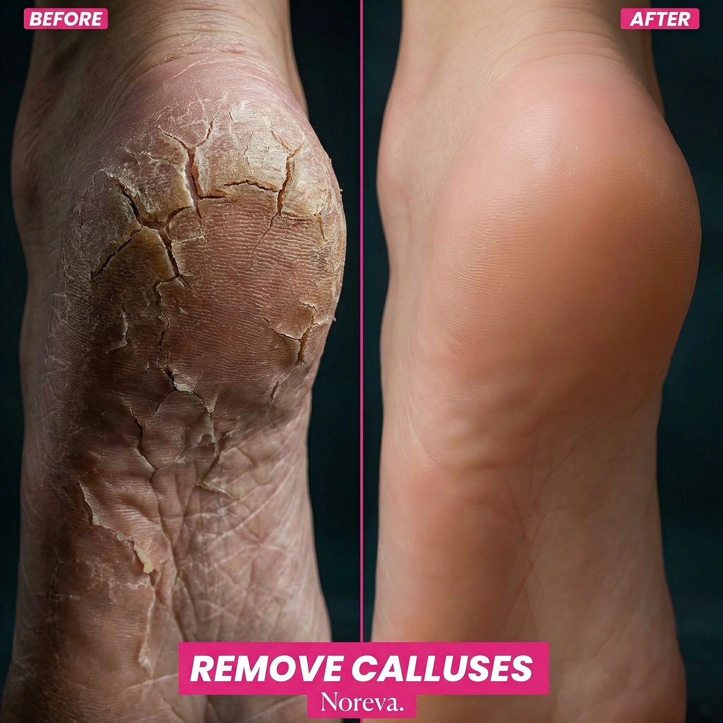 Noreva FootGlow Callus Remover