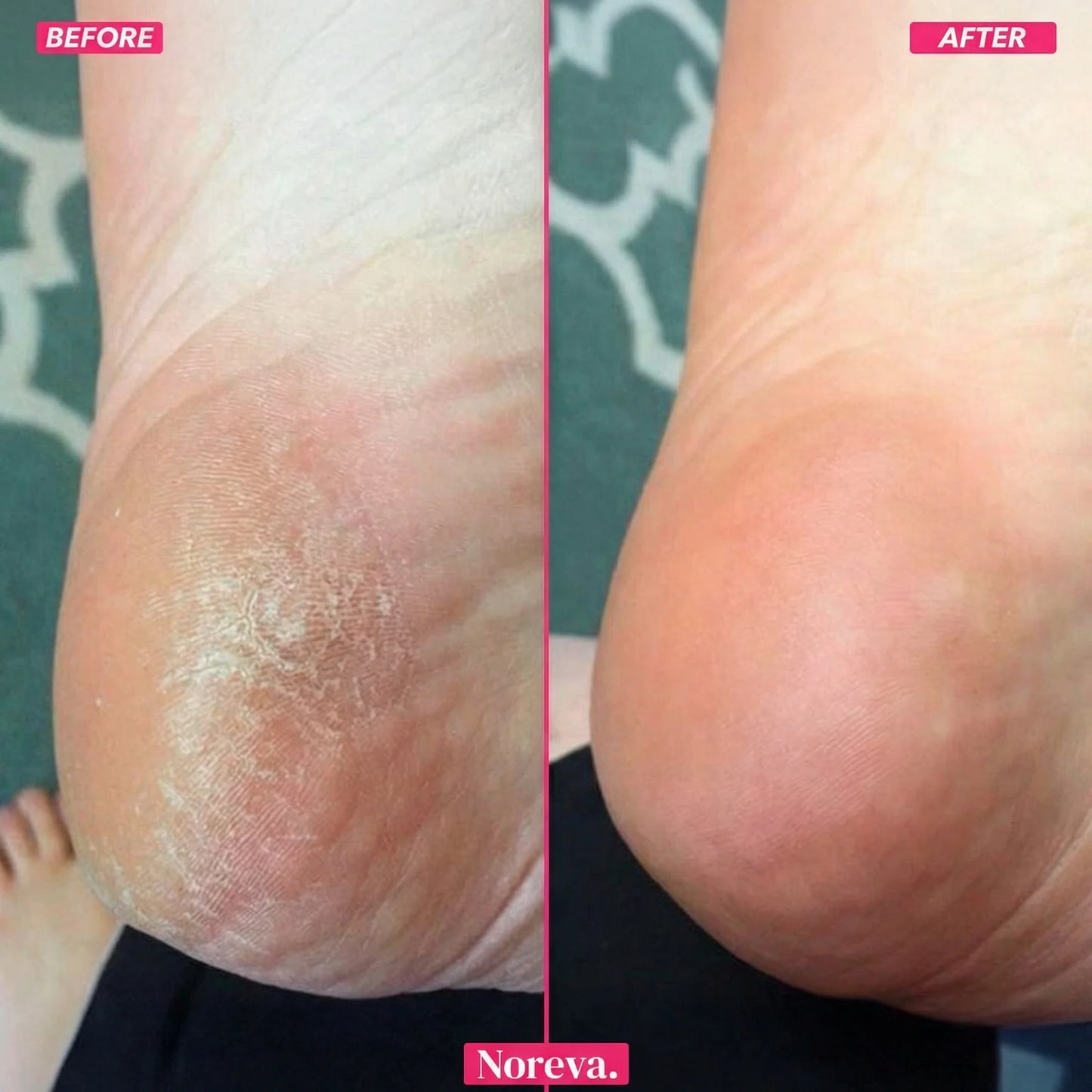 Noreva FootGlow Callus Remover