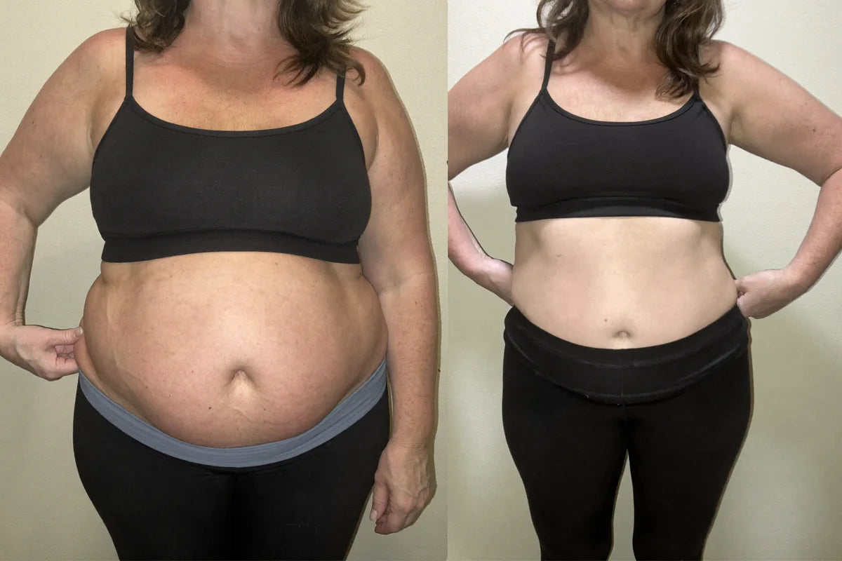 Sarah M. before and after Noreva — 21 days